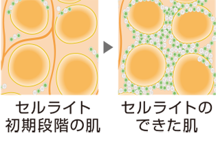 図：セルライトバーンイメージ