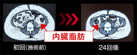 図:施術後の内臓脂肪減少の様子